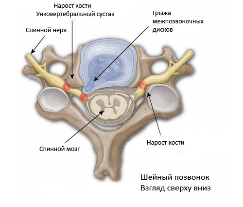 Симптоми и лечение на ревматоиден артрит на гръбначния стълб