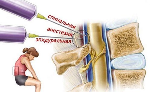 Симптоми и лечение на Schmorl херния на гръдния кош