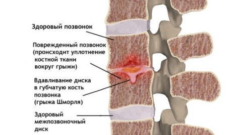Симптоми и лечение на Schmorl херния на гръдния кош
