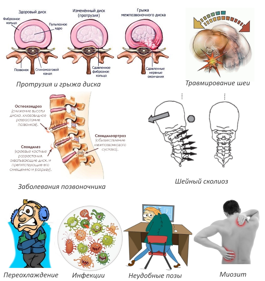 Симптоми на радикулопатия на цервикалния гръбначен стълб С5-С6