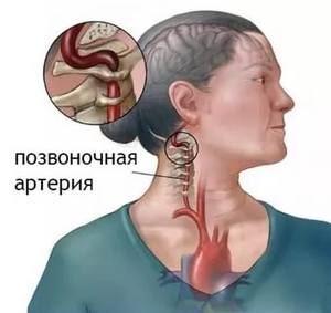 Синдром на гръбначната артерия с цервикална остеохондроза: причини, симптоми и лечение