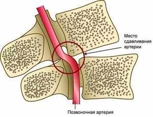 Синдром на гръбначната артерия с цервикална остеохондроза: причини, симптоми и лечение