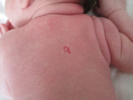 Появата на хемангиома при новородени