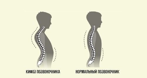 Причините и видовете кривина на гръбначния стълб при хората