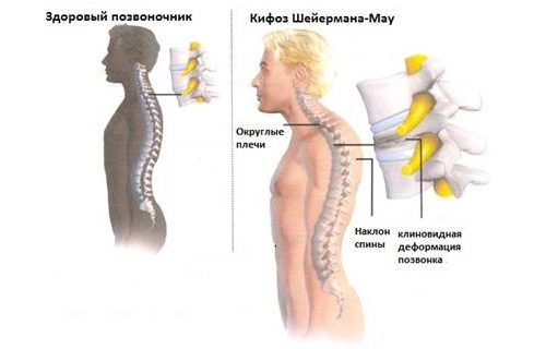 Причините и видовете кривина на гръбначния стълб при хората