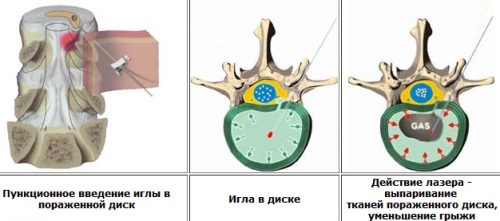 Основните видове операции за отстраняване на лумбалната херния