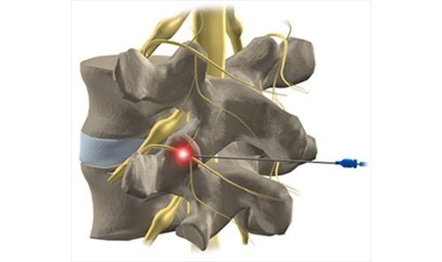 Основните видове операции за отстраняване на лумбалната херния
