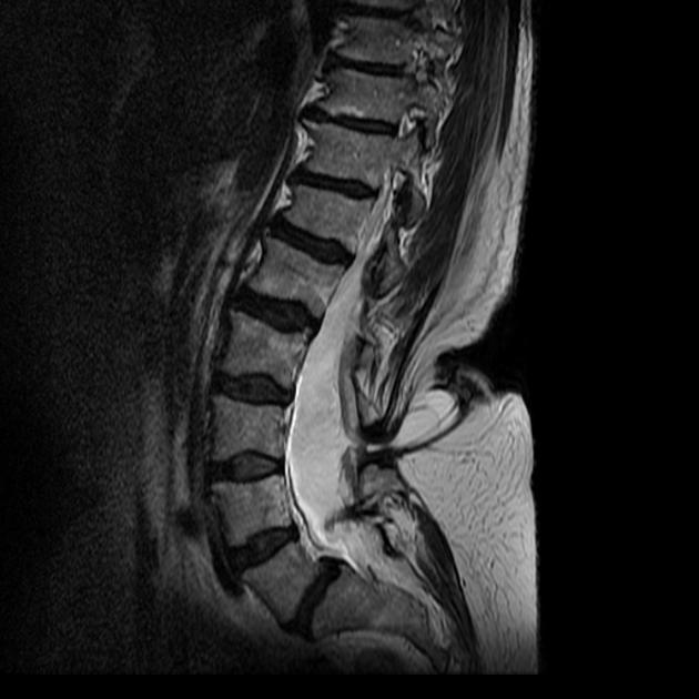 Проявата на гърба на Bifida (Spina Bifida) при деца и възрастни