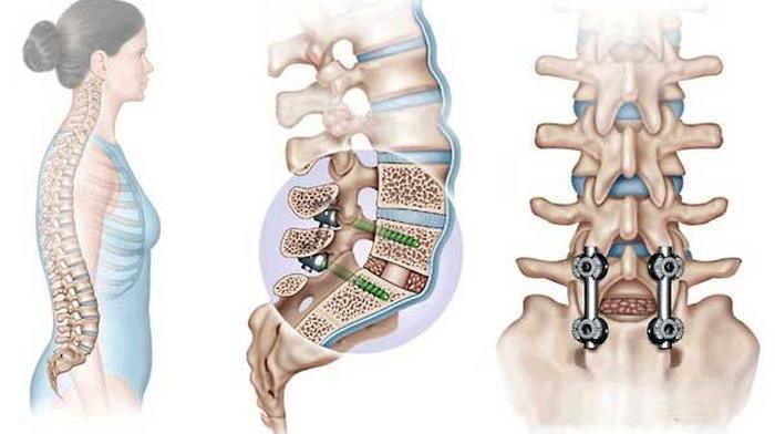 Транспипедикуларно фиксиране на гръбначния стълб: когато е направено, какво дава, цената на операцията