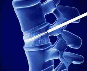 Лечение на компресионната фрактура на гръбначния стълб: ефективни методи и мерки за рехабилитация