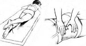 Лечение на междуведомствената херния на лумбосакралния гръбнак: преглед на ефективните методи
