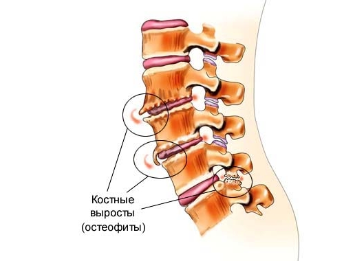 Лечение на остеофилите на цервикалния и лумбалния гръбнак