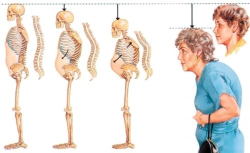 Лечение на остеопороза на лумбалния, гръдния, цервикалния гръбначен стълб