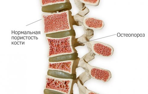 Лечение на остеопороза на лумбалния, гръдния, цервикалния гръбначен стълб