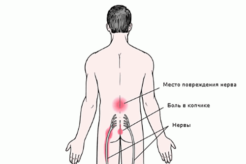 Лечение на радикулопатия на лумбосакралния гръбначен стълб