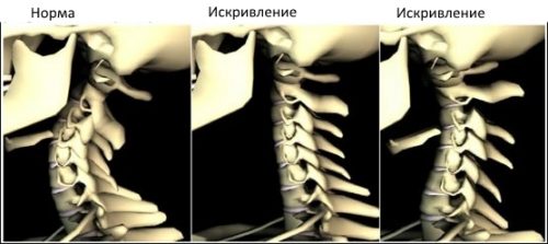 Лечение на сколиоза на цервикалния гръбначен стълб