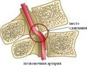 Лечение на синдрома на гръбначните артерии с цервикална остеохондроза