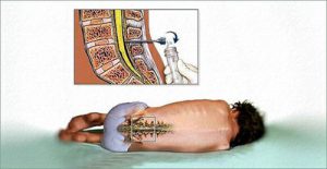 Видове епидурални на гръбначния стълб и сложността на лечението