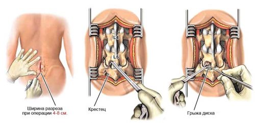 Видове епидурални на гръбначния стълб и сложността на лечението