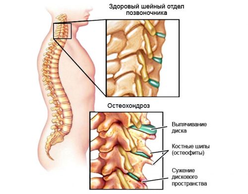 Подобряване на церебралната циркулация при остеохондроза на шията