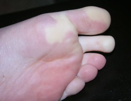 Какво може да причини изтръпване на палеца на крака?