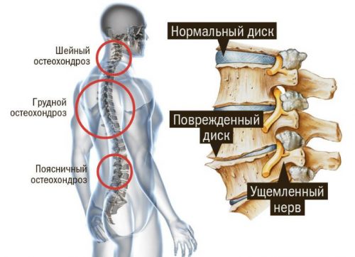 Какви мускулни релаксанти се използват за лечение на остеохондроза?