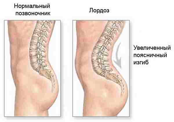 Изкривяване на гръбнака: причини, признаци и степени на развитие, методи на лечение