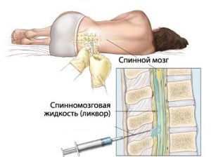 Как да премахнете болката в гърба след епидурална анестезия?