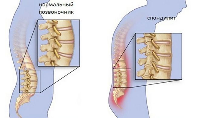 Туберкулоза на гръбначния стълб: причини, симптоми и съвременно лечение