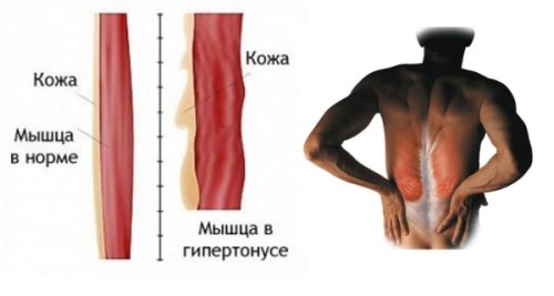 Kalmireks е ефективно средство за лечение на мускулни спазми