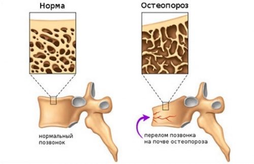 Osteomed - хранителни добавки за лечение на остеопороза на костите