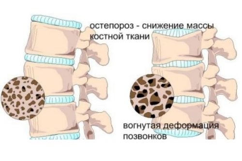 Приложение на лекарствената фороза при остеопороза