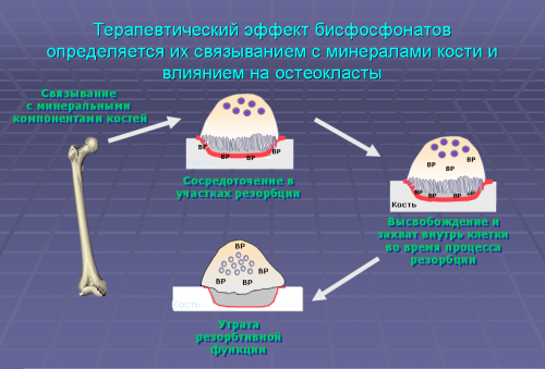 Употребата на Bonefos при остеопороза