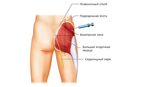 Употреба на лекарството Meloksikam под формата на инжекции