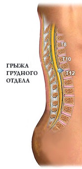 Болка в долната част на гърба и между лопатките