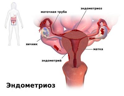 Болка в долната част на гърба и корем с менструация