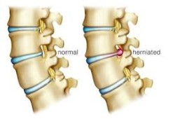 Причини за болка в гърба точно над долната част на гърба на каузата