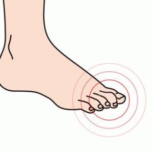 Деформация на пръстите на краката