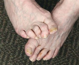 Деформация на пръстите на краката