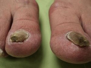 Болести на ноктите на краката