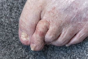 Микроза на краката
