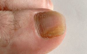 Гъбични заболявания на ноктите на краката