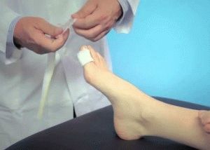 Възпаление на нокътната ролка на крака