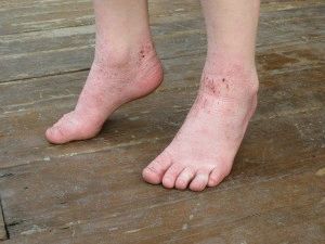 Лечение на екзема на краката с мазила
