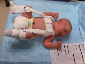 Недостатъчно развитие на тазобедрените стави при новородени
