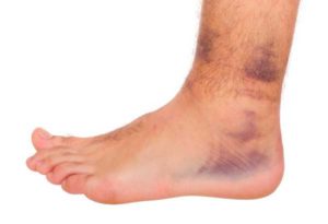 Болести на краката при хора и тяхното лечение