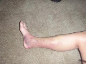 Болести на краката при хора и тяхното лечение