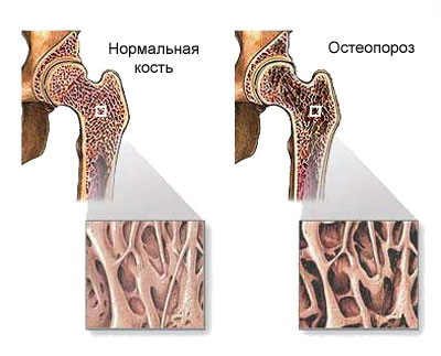 остеопороза