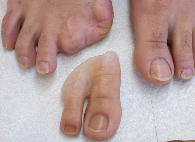 Ампутация на пръст на крака със захарен диабет