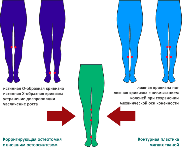 Извити крака - как да се определи